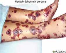 funscrape.com Purpura