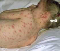 Rash