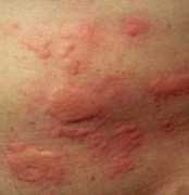 Rash