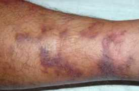 Sarcoma