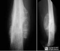 Sarcoma