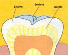 Sealant
