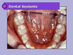 rainbowdentalbahamas.com Sealants