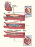 Stent