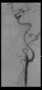 Stent