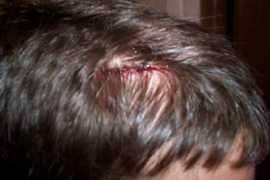 photos.wakeboarder.com Stiches