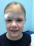 Stitches