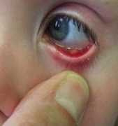 Stye