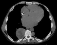 radpod.org Thalassaemia