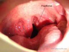 Tonsil