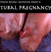 Tubal