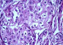 Tumor