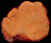 Tumor