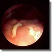 endoskopischer-atlas.de Ulkus
