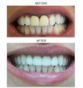 Veneer