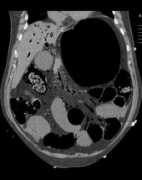 Venous